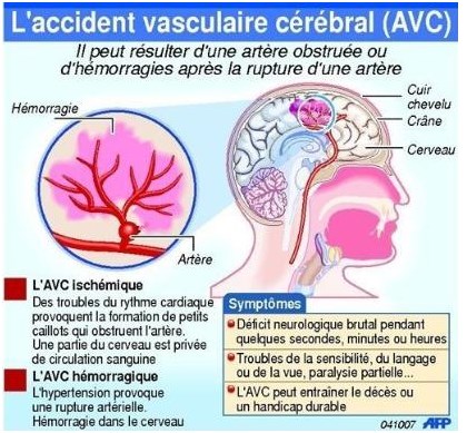 Accident vasculaire cérébrale