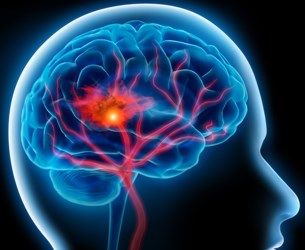 Article : L&rsquo;accident vasculaire c&eacute;r&eacute;bral, un probl&egrave;me majeur de sant&eacute; publique !